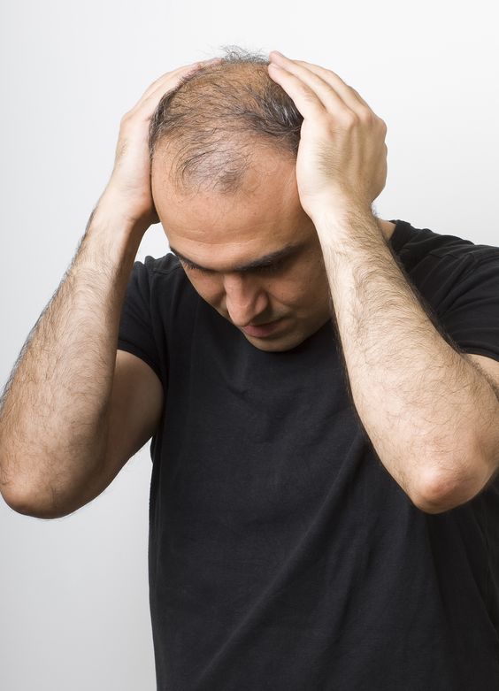 Por qué se me cae el pelo: causas que provocan alopecia